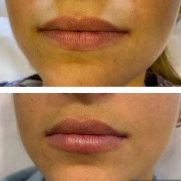 Aumento-de-labios-muy-sutil-3