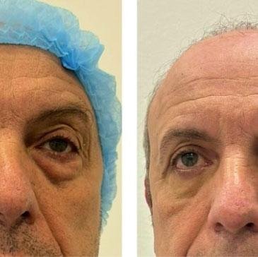 Blefaroplastia-inferior-en-hombre