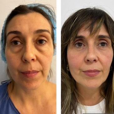 Blefaroplastia-inferior