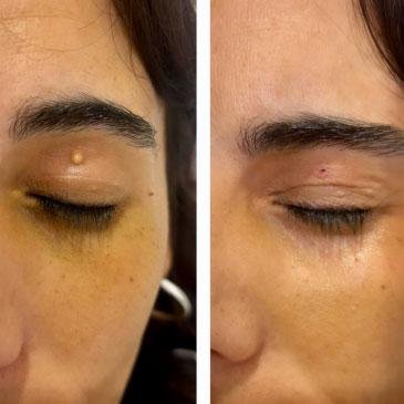 extirpación-de-lesión-cutánea-benigna extirpacion de lesion cutanea benigna