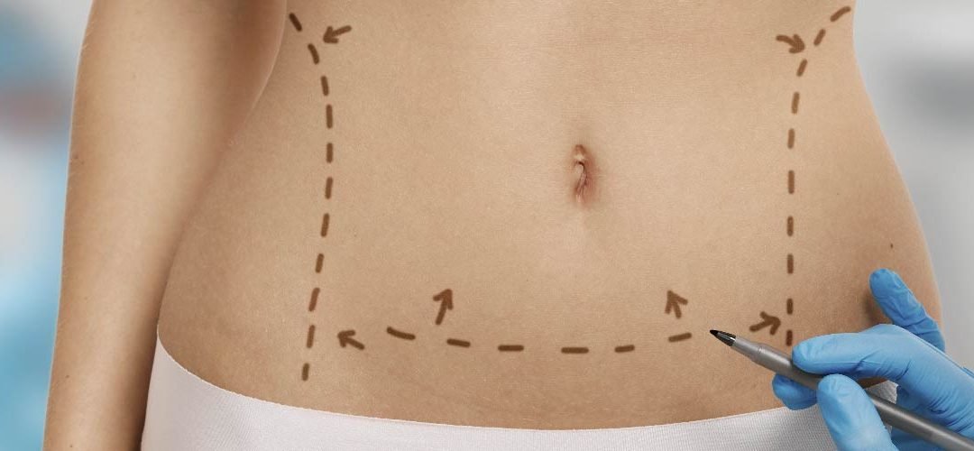 Abdomen sano y firme con Abdominoplastia en Donostia