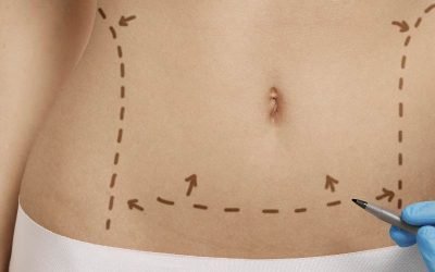 Abdomen sano y firme con Abdominoplastia en Donostia