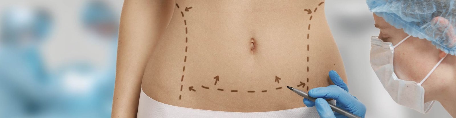 abdominoplastia Reducción de abdomen