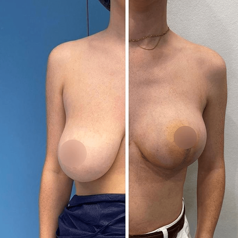 Cirugía de pecho sin implantes caso real a los 15 días-1