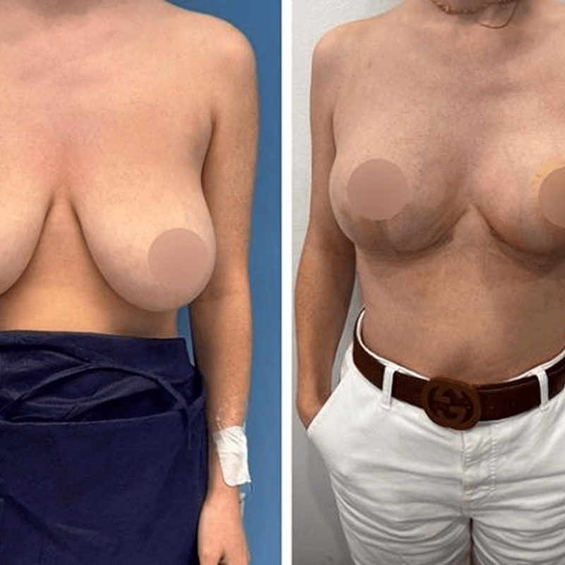 Cirugía de pecho sin implantes caso real a los 15 días-6