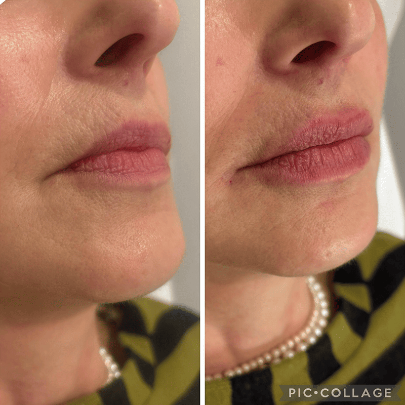 Acido Hialuronico en labios-1