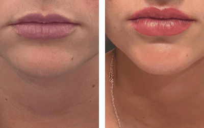 Acido Hialuronico en labios 2