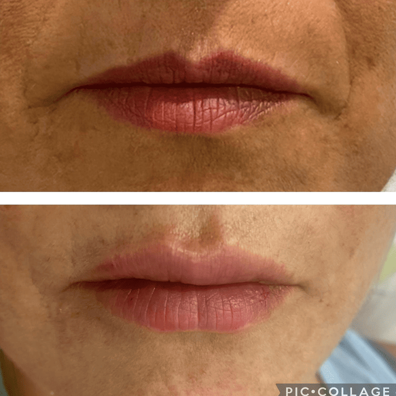 Acido Hialuronico en labios 2-2