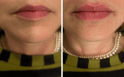 Acido Hialuronico en labios