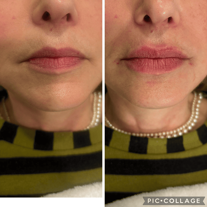 Acido Hialuronico en labios-2