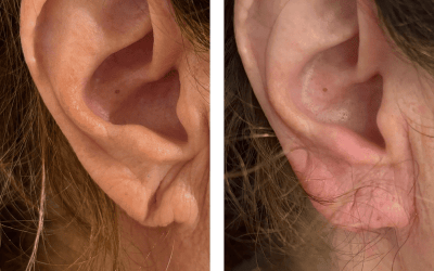 Ácido hialurónico en lóbulo auricular