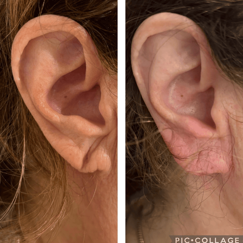 Ácido hialurónico en lóbulo auricular