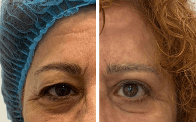 Blefaroplastia