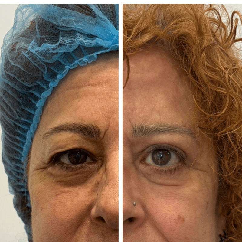 Blefaroplastia-1
