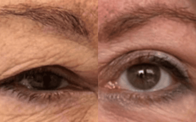 Blefaroplastia 2