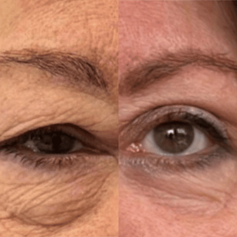 Blefaroplastia 2