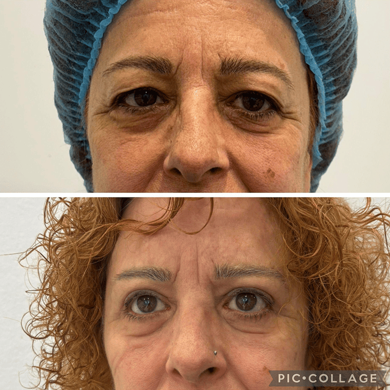 Blefaroplastia-2