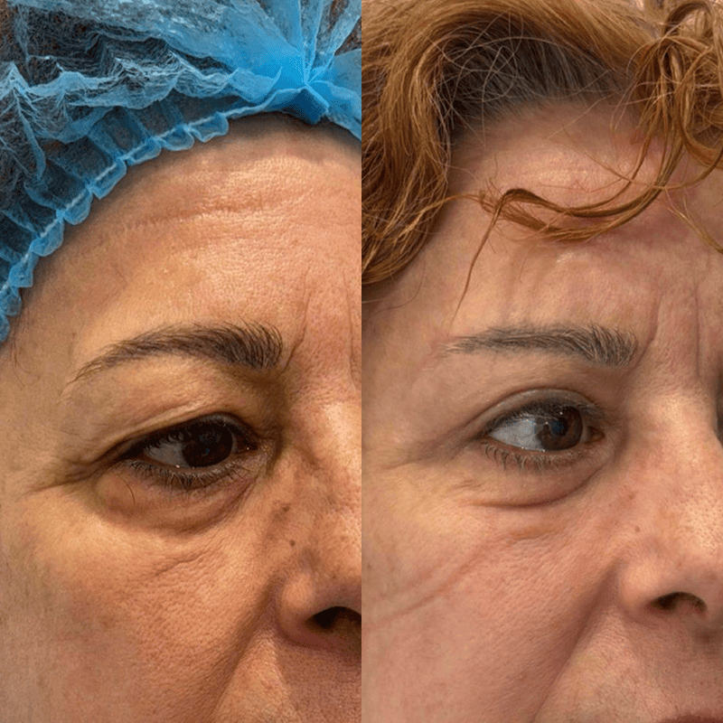 Blefaroplastia-3