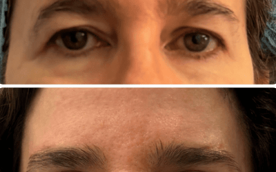 Blefaroplastia superior con lifting de ceja