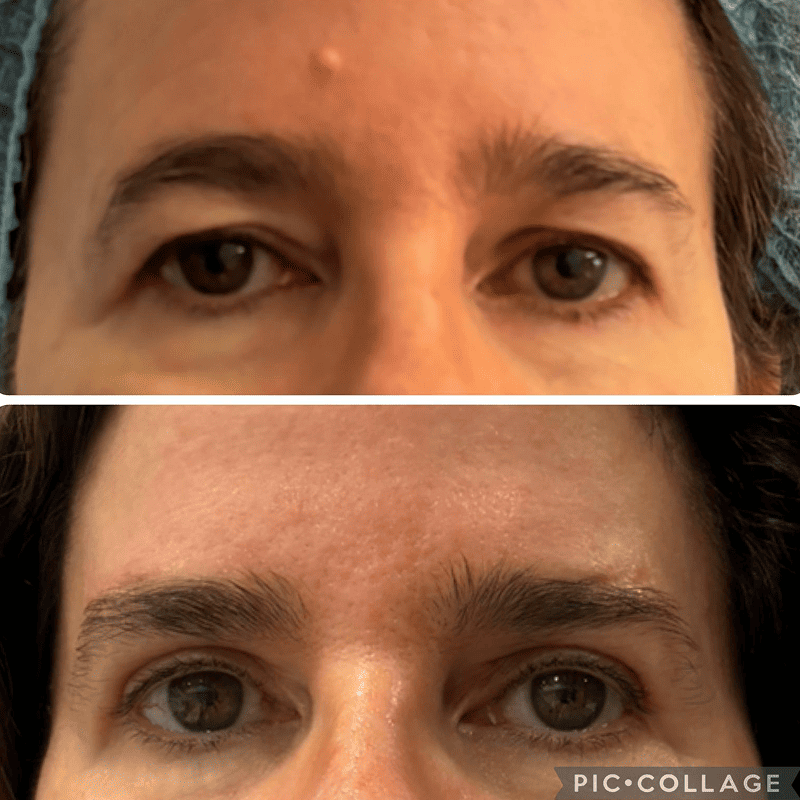 Blefaroplastia superior con lifting de ceja