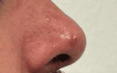 Extirpación de lesión nasal