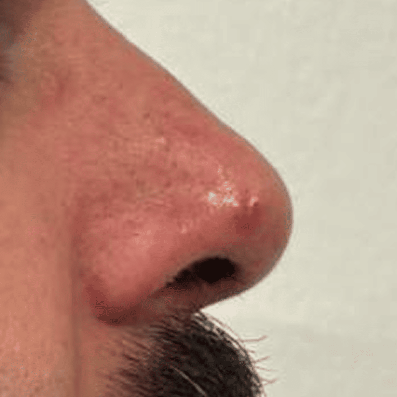 Extirpación de lesión nasal-1