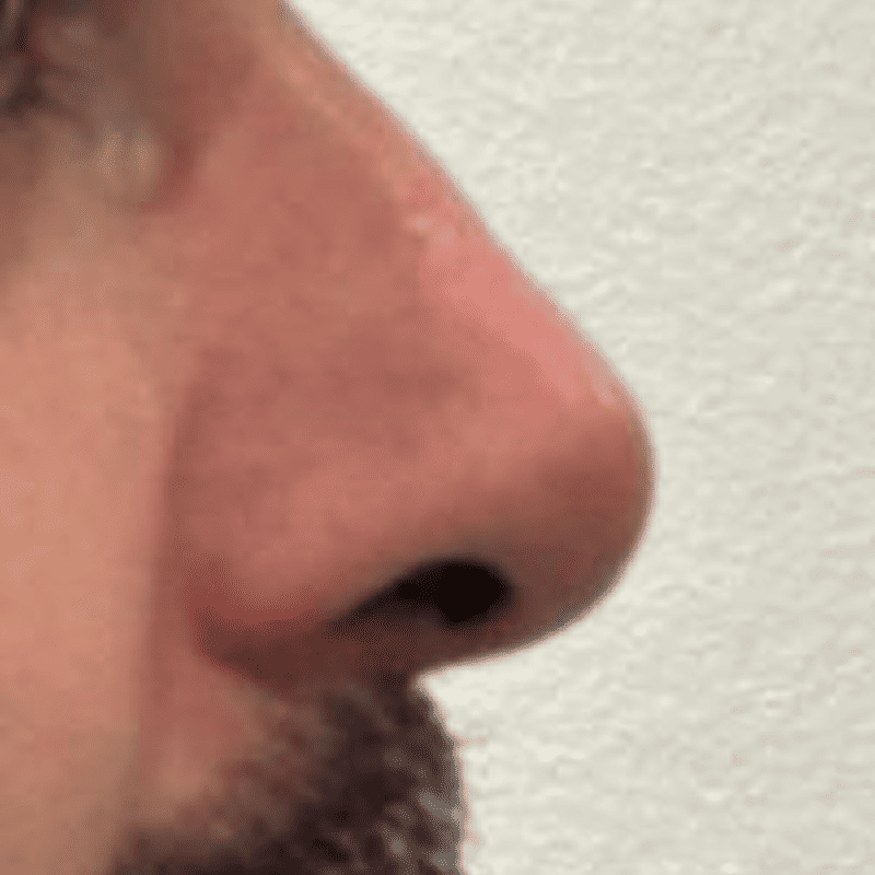 Extirpación de lesión nasal-2
