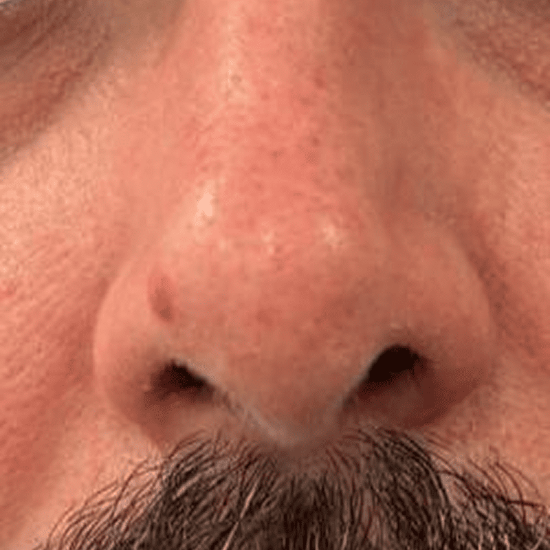 Extirpación de lesión nasal-3