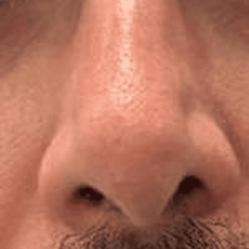 Extirpación de lesión nasal-4