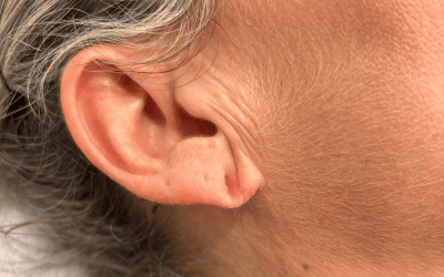 Infiltración de ácido hialurónico en lóbulo auricular