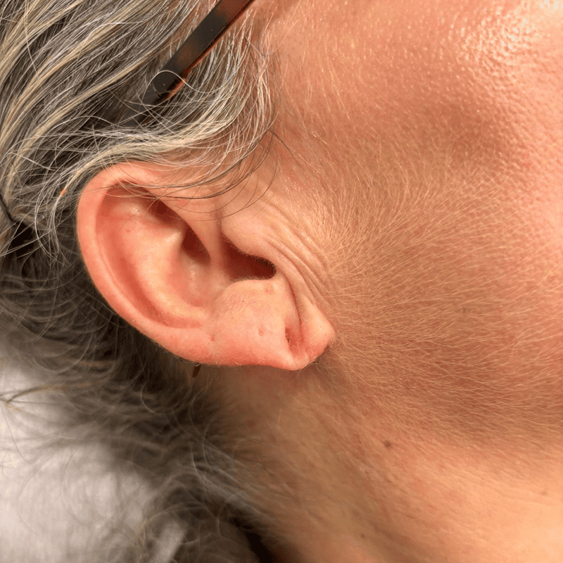 Infiltración de ácido hialurónico en lóbulo auricular-1