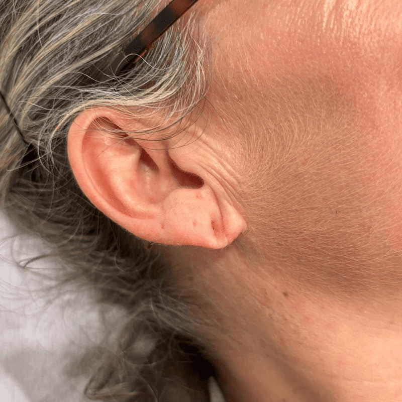 Infiltración de ácido hialurónico en lóbulo auricular-2