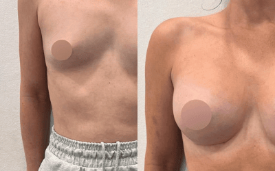 Mamoplastia de aumento con implante redondo