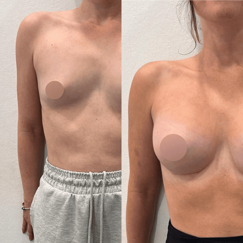 Mamoplastia de aumento con implante redondo