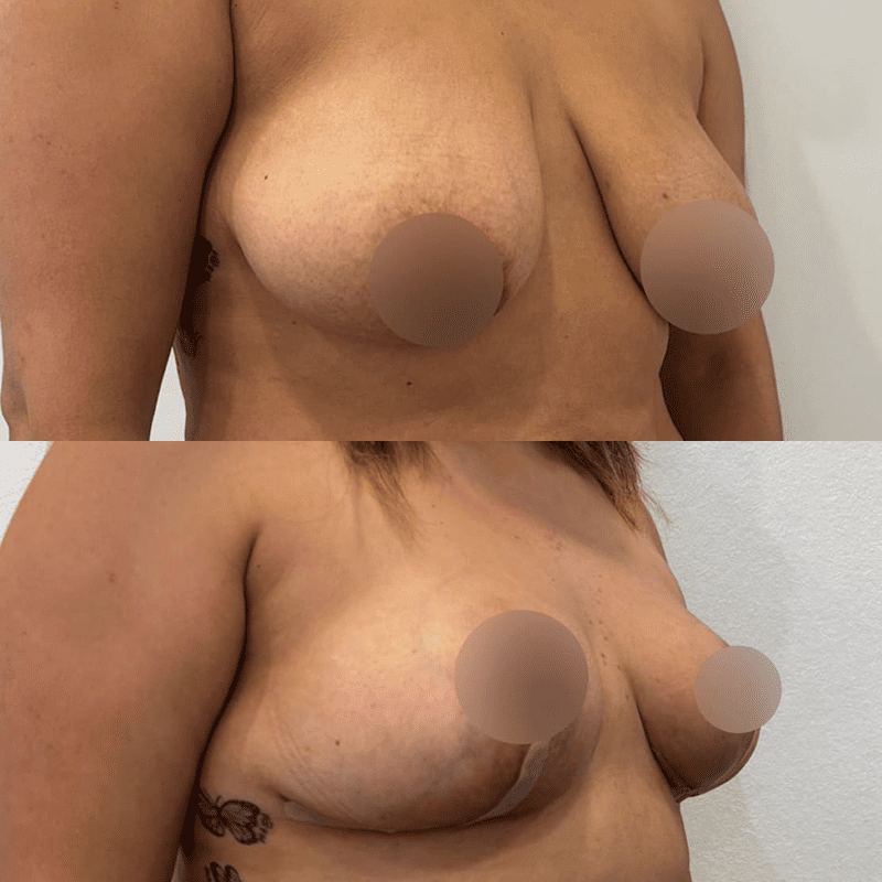 Mastopexia sin prótesis-3